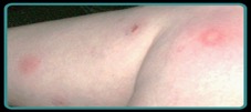 bird flea bites