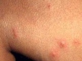 dog flea bites