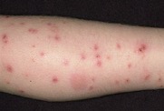 cat flea bites
