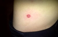 tick bite